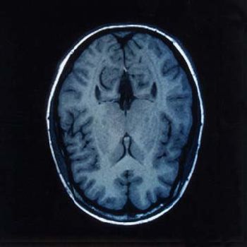 MRI - Brain